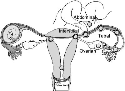 location of ectopic.jpg