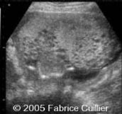 molar pregnancy on TVS.jpg