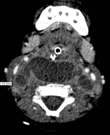 PDMR upper airway fig 2.pdf