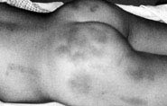 PDMR0712 fig 1 bruises.jpg