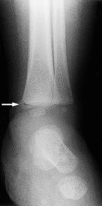 PDMR0712 fig 3 metaphyseal bucket handle fracture.JPG
