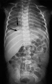 PDMR0712 fig 4 posterior rib fracture.JPG