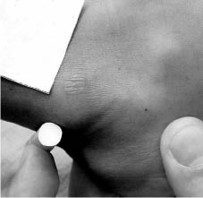 PDMR0712 fig 7 cigarette burn.jpg