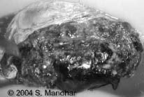 placental abruption with retroplacental clot image b.jpg