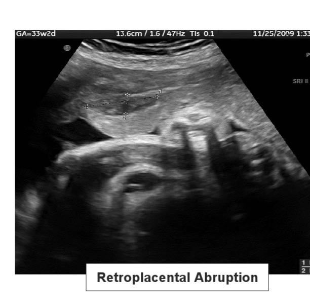 retroplacental abruptionBW_0001.jpg