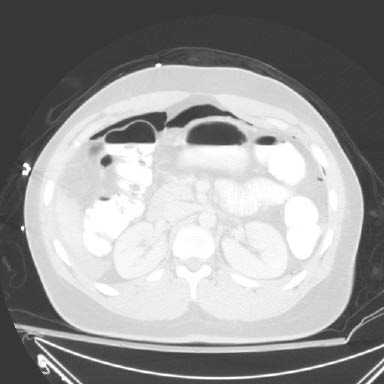 Figure 9b -pneumoperitoneum.jpg