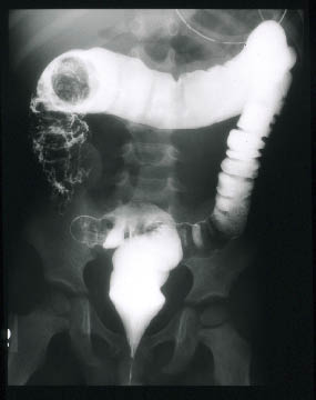 INTUSSUSCEPTION2.png