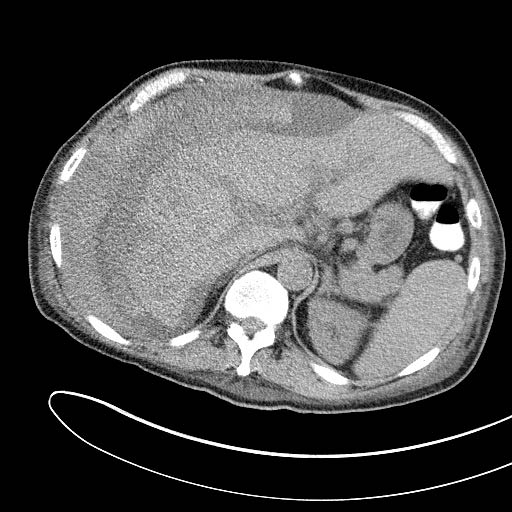 Figure_6b_CT_perihep_hematoma.jpg