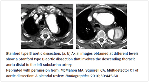 Stanford Type B Aortic Dissection