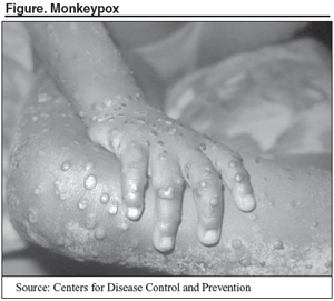 Monkeypox