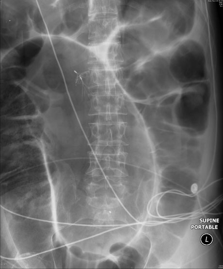 Figure_4_sigmoid_volvulus.jpg