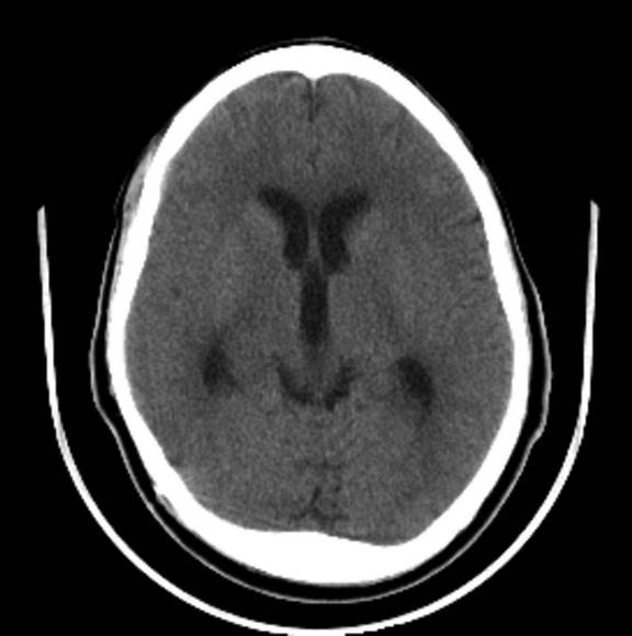 Head CT Showing Hydrocephalus