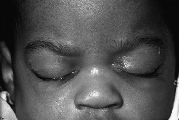 Conjunctivitis