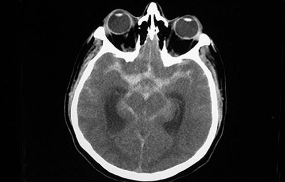 Intracranial Hemorrhage