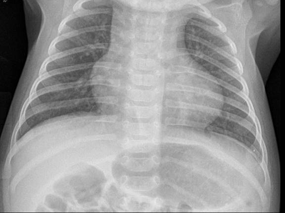 Boot shaped heart: Tetralogy of Fallot