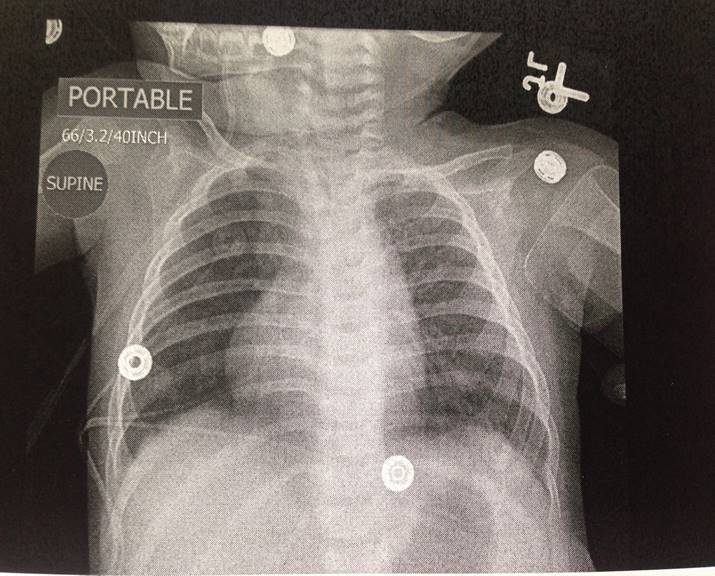 Dextrocardia
