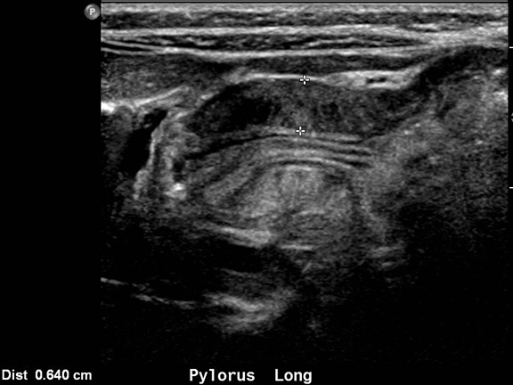 Pyloric Stenosis