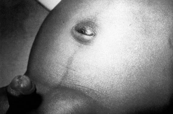 Hernia