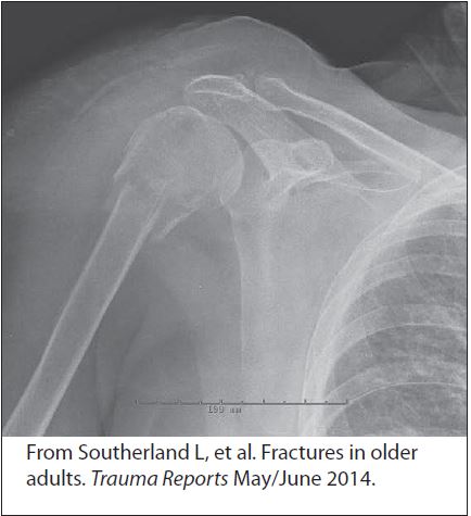 Figure 1. Proximal Humerus Fracture