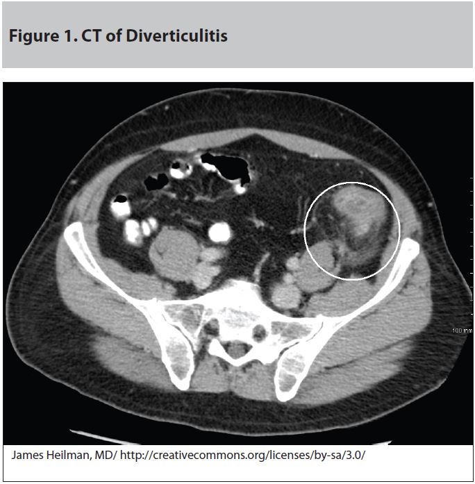 Figure 1. CT of Diverticulitis