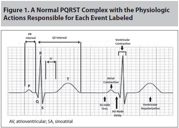 Figure 1 A Normal PQRST Complex with the Physiologic Actions Responsible for Each Event Labeled.