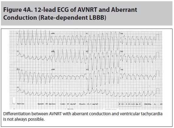Figure 4A 12 lead ECG of AVNRT and Aberrant Conduction.JPG