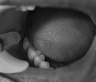 buccal