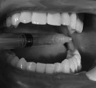 inferior alveolar 1