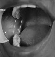inferior alveolar 2