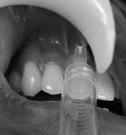 superior alveolar