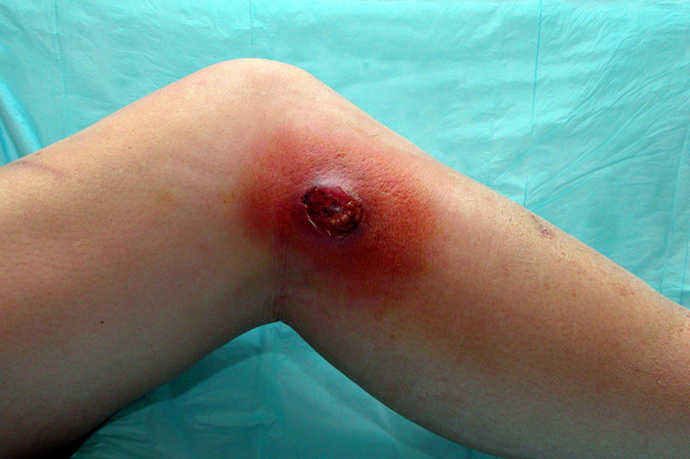 cellulitis