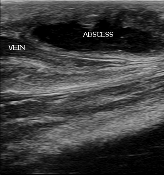 abscess