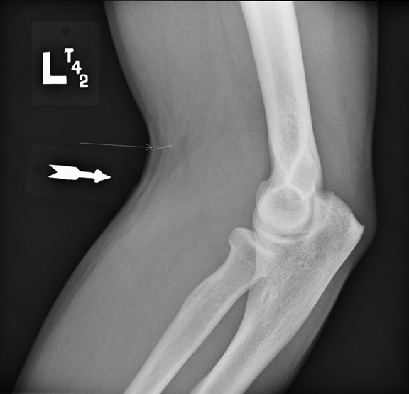 retained needle