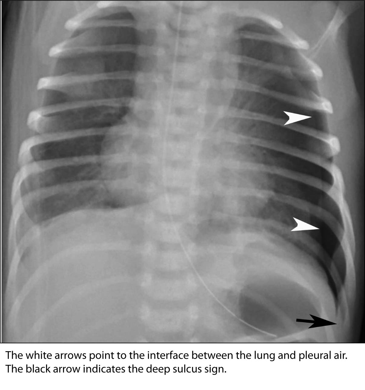 pneumothorax