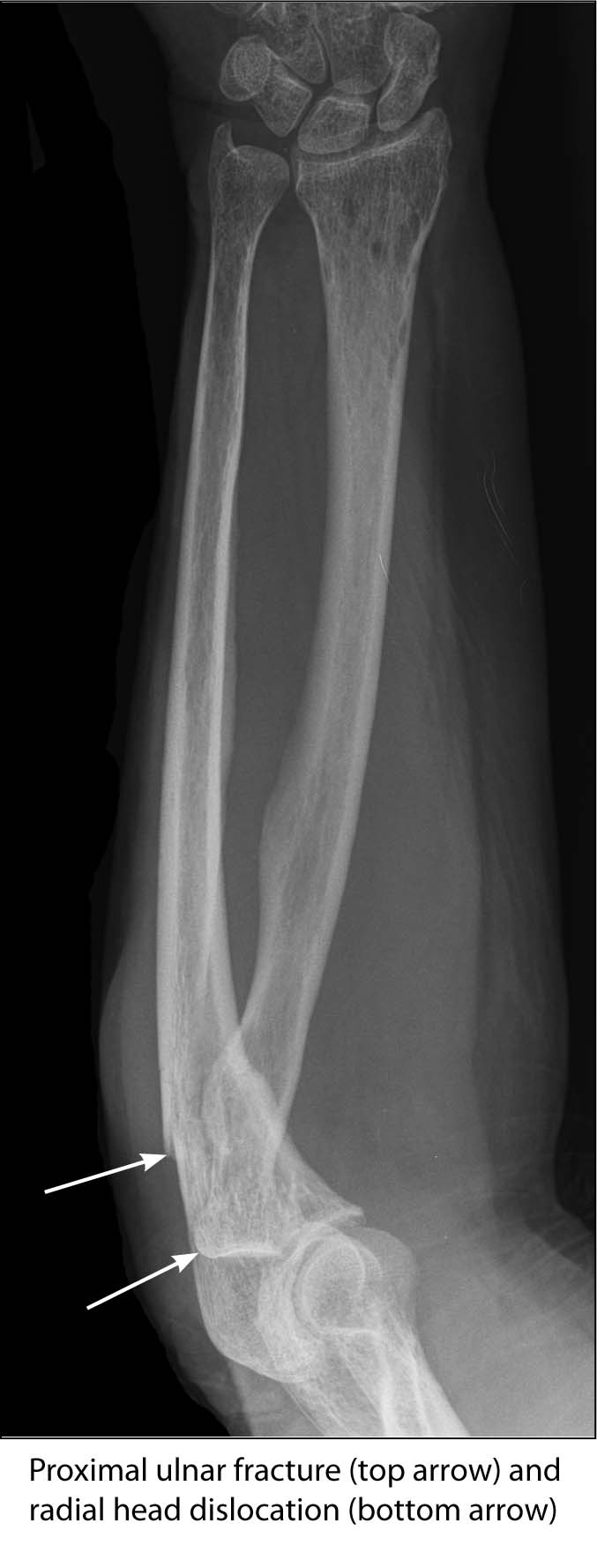 Monteggia fracture dislocation