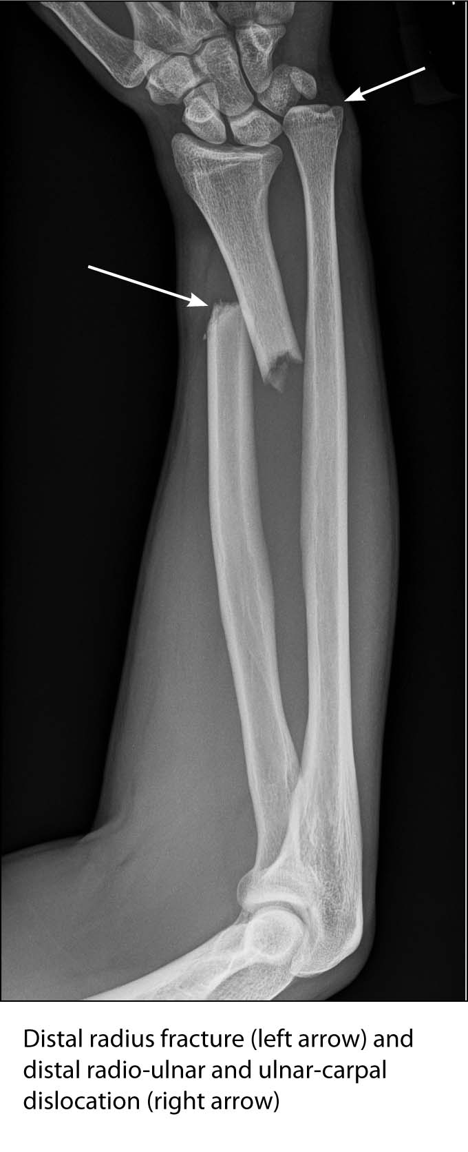 Galeazzi fracture dislocation