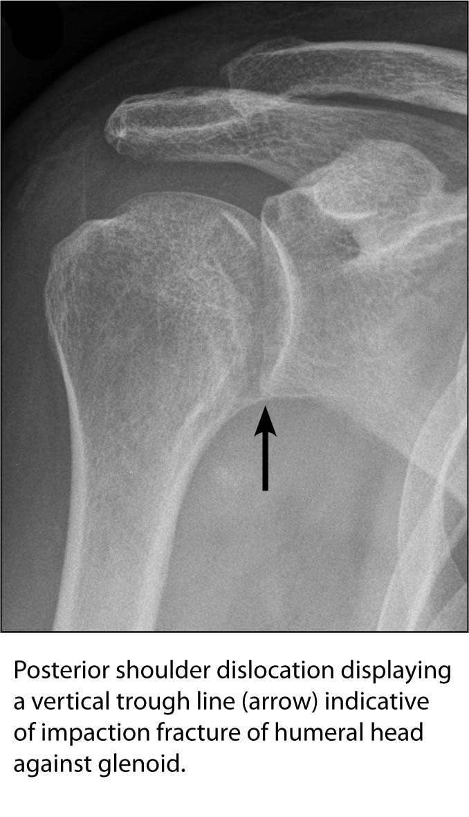 shoulder dislocation