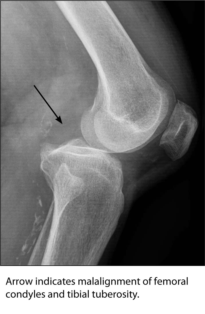 knee dislocation