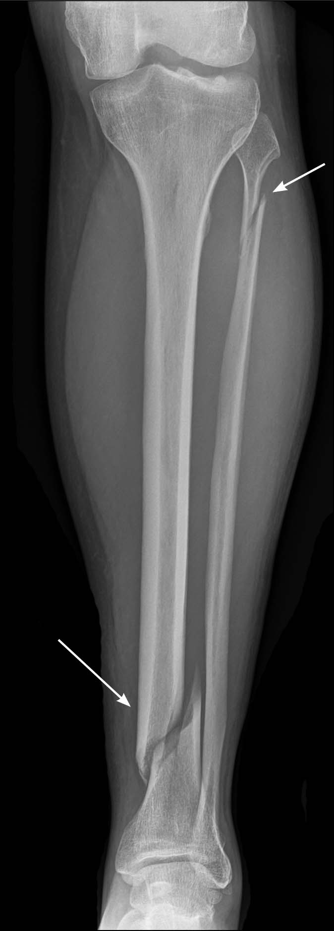 Maisonneuve fracture