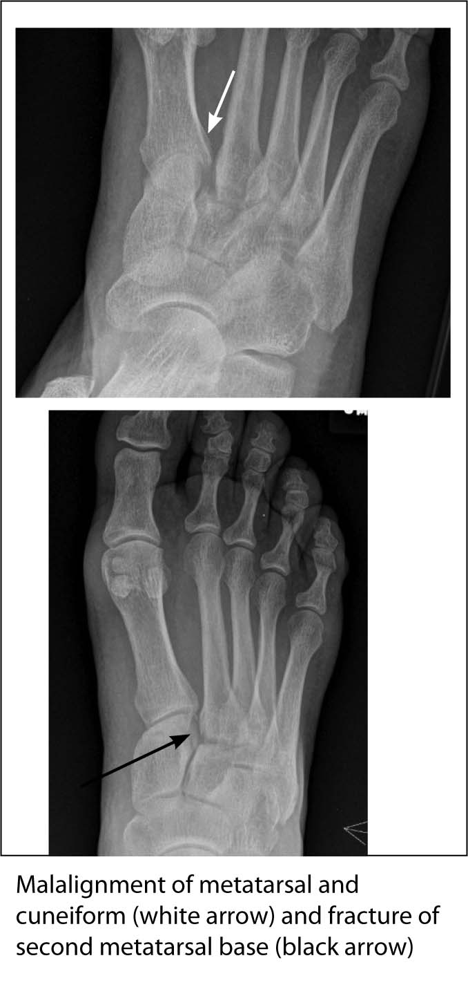 Lisfranc fracture dislocation