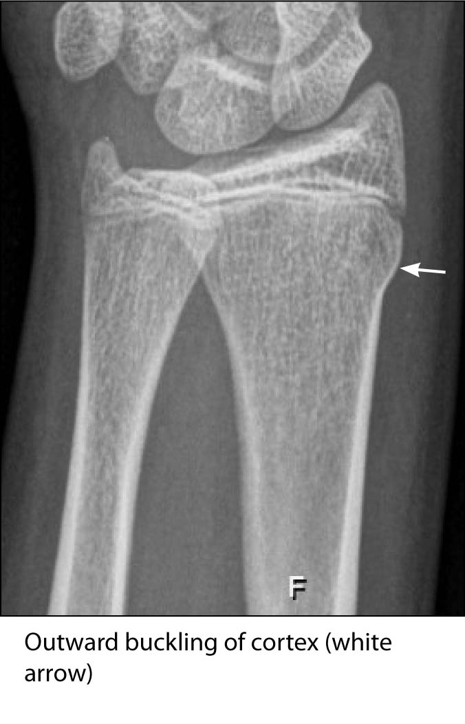 buckle fracture
