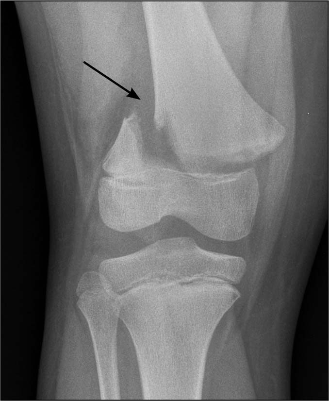 Salter Harris II fracture