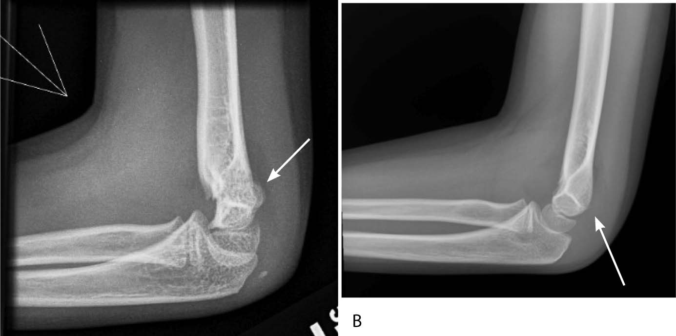 supracondylar fracture