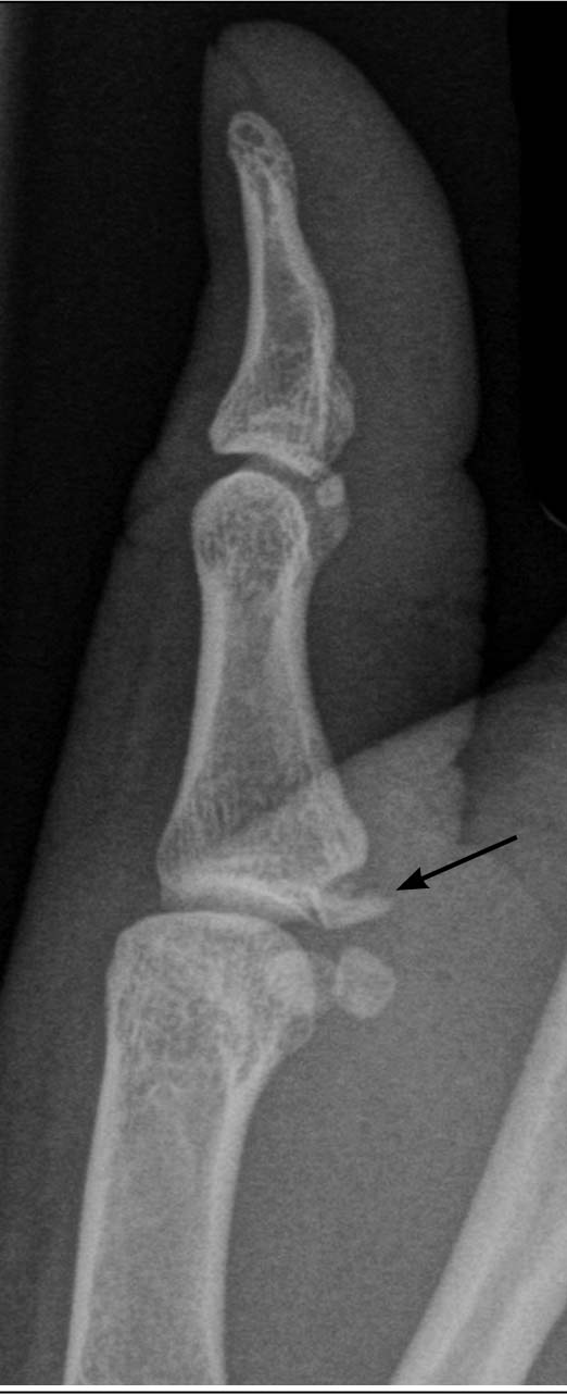 gamekeeper's thumb