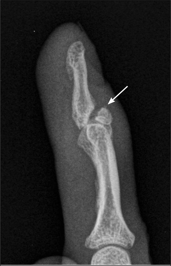 mallet finger