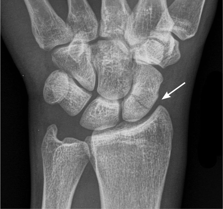 scaphoid fracture