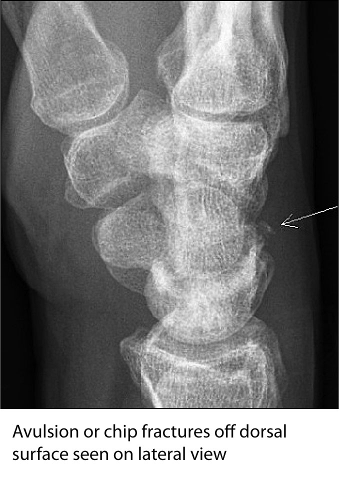 triquetral fracture
