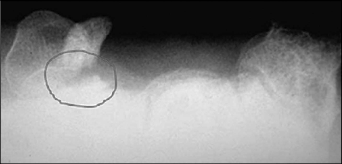 hook of hamate fracture