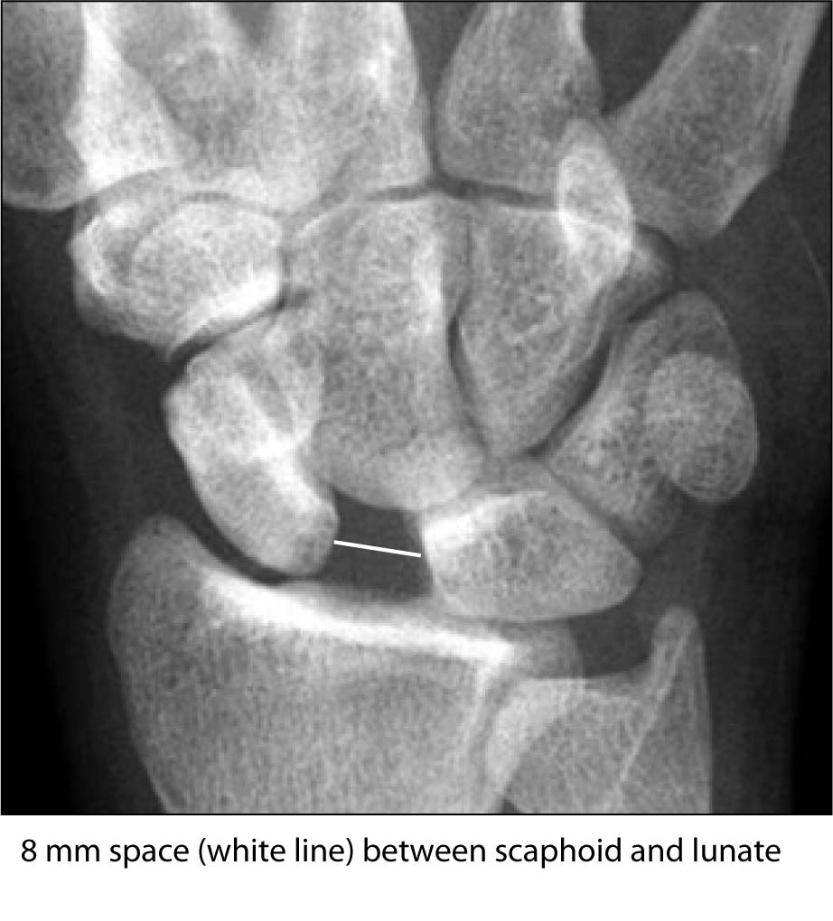 scapholunate dislocation