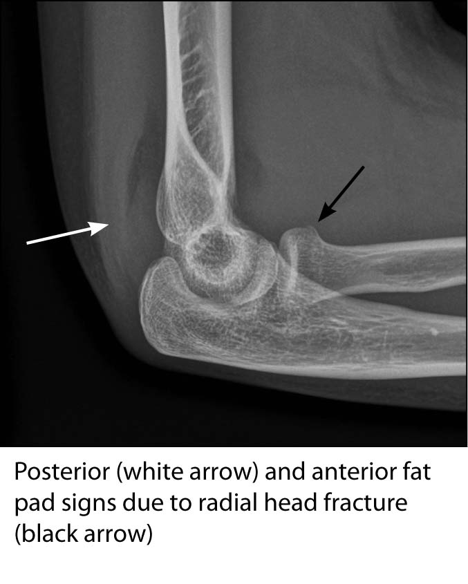 radial head fracture